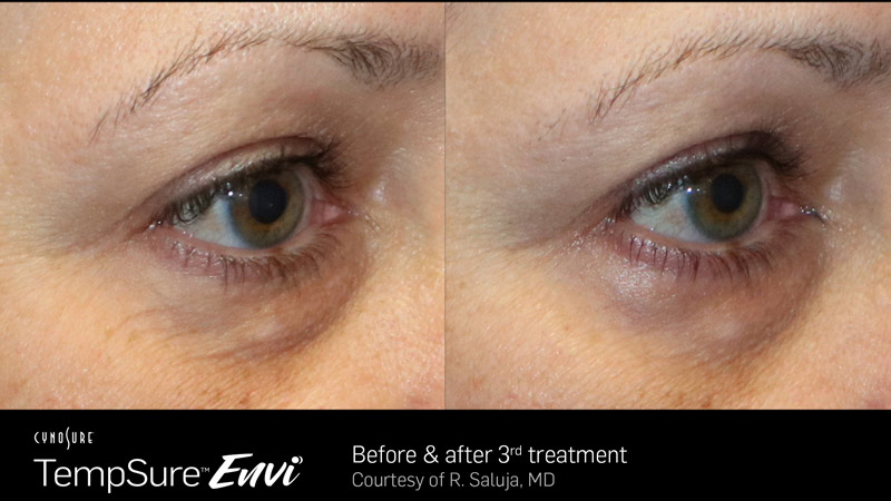 TempSure-Envi-Before-and-After-Image_20