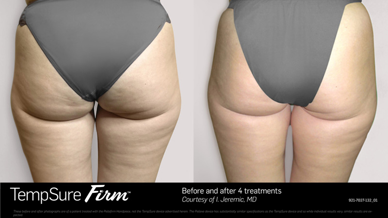 TempSure_Firm_BAw3